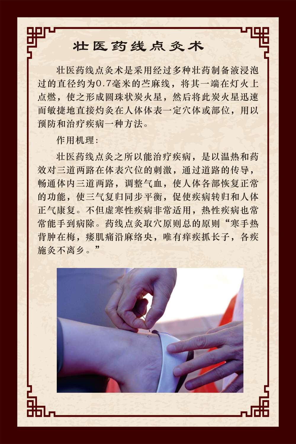 药线点灸